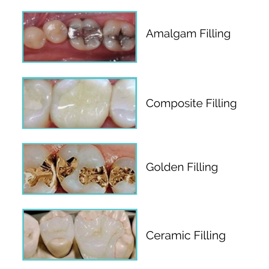 Tooth Filling, Stop Tooth Decay